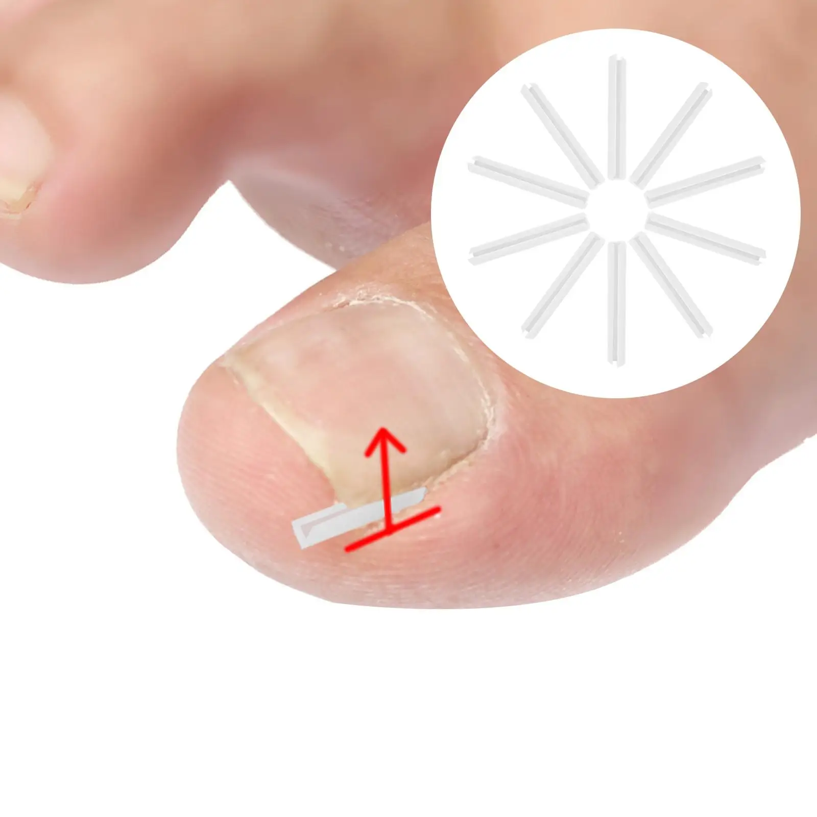10 шт., корректирующие полоски для вросших ногтей