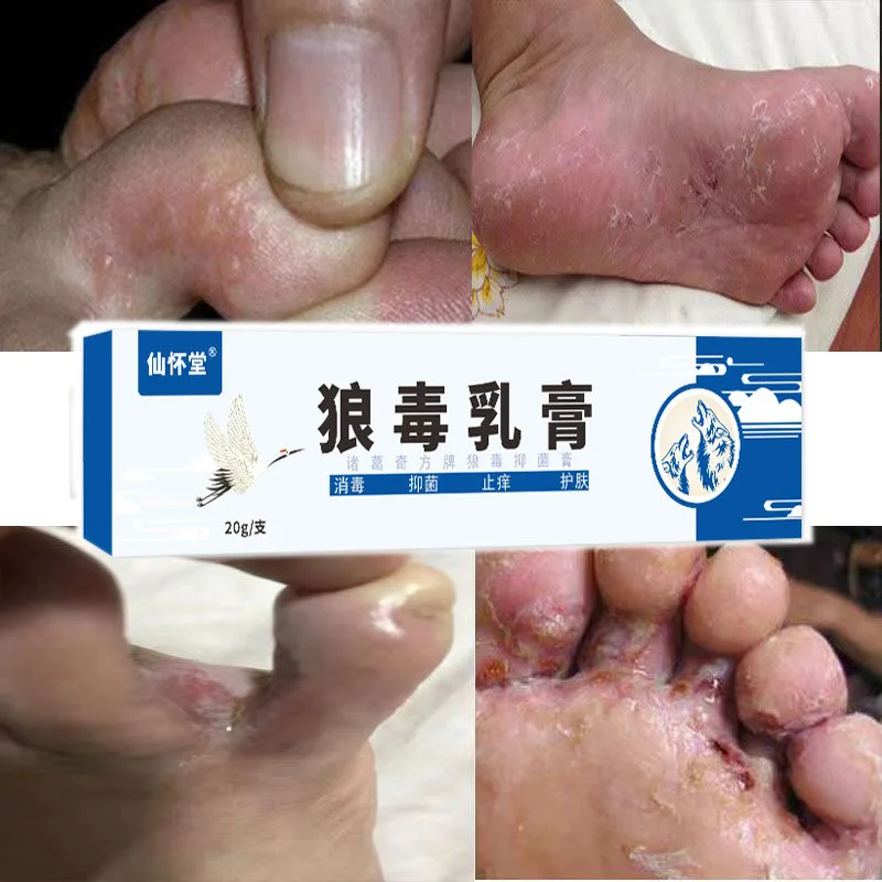 

Removes Fungi on the Feet Cream Itchy Peeling Feet Rotten Feet Sweaty Feet Foot Care Antibacterial Cream Athlete's Foot Cream