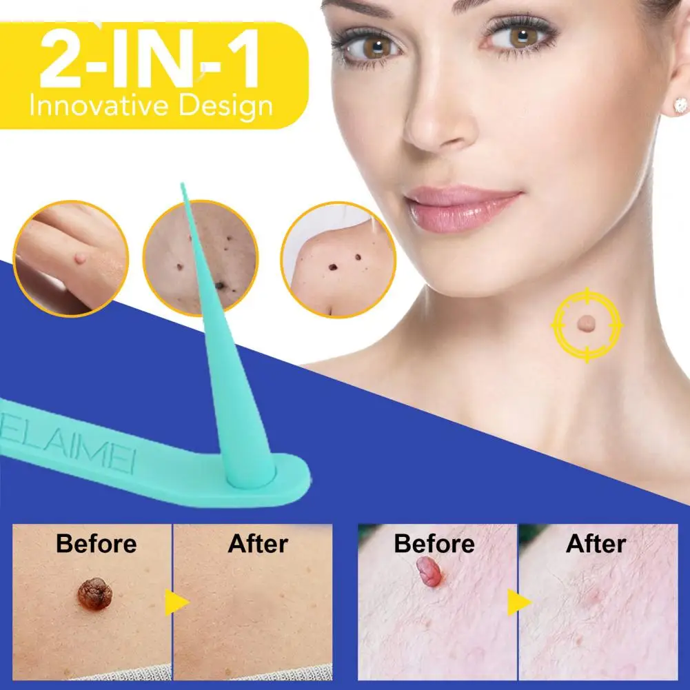 

1Set Universal Wart Removal Tool Painless Professional Mini Acne Remover Minimalistic Plastic Skin Tag Removal Tool for Women
