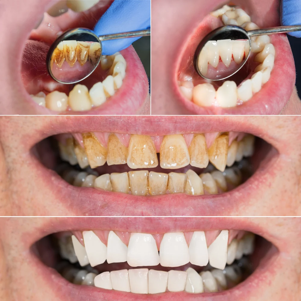 Электрический стоматологический аппарат для чистки зубов устройство очистки