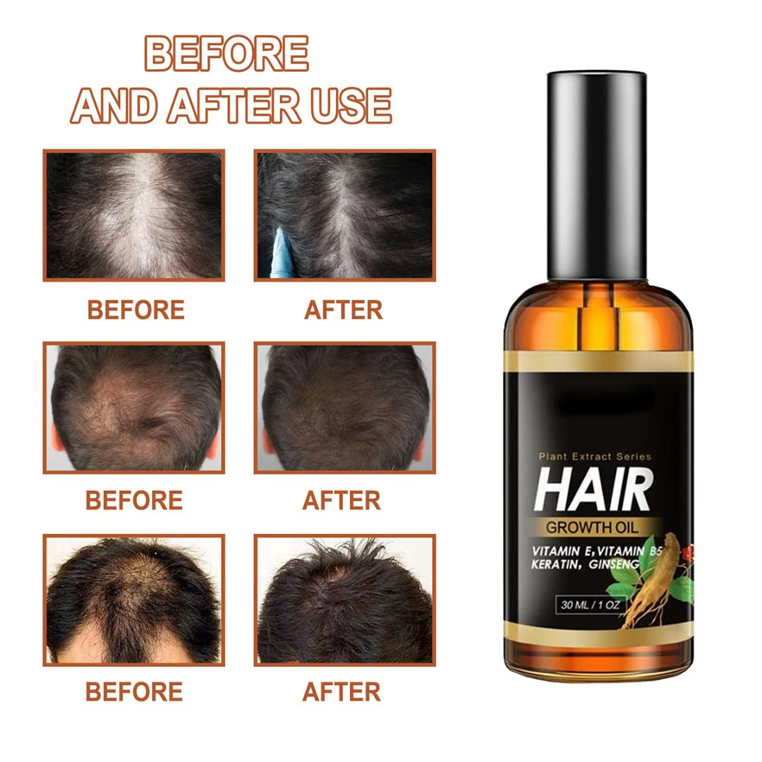 

1 Pc 30ml Hair Growth Oil Ginger Essence Serum Hair Loss Fast Growing Hair Essential Oil Hair Care For Men Women