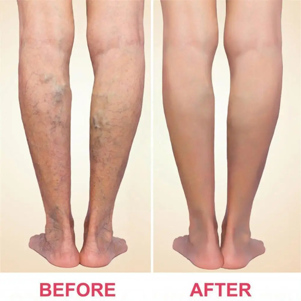 

Крем для лечения варикозного расширения вен, 20 г