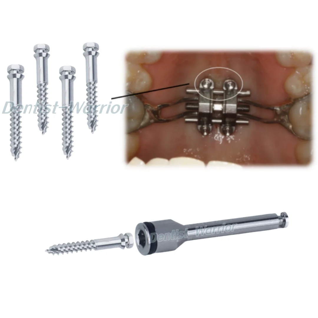 MSE стоматологический ортодонтический расширительный винт для среднего лица