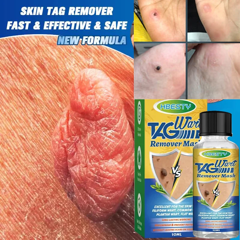 

Wart Removal Essential Oil Remover Skin Tags Treatment Papillomas Body Flat Wart Painless Repair Black Spot Beauty Herb Care