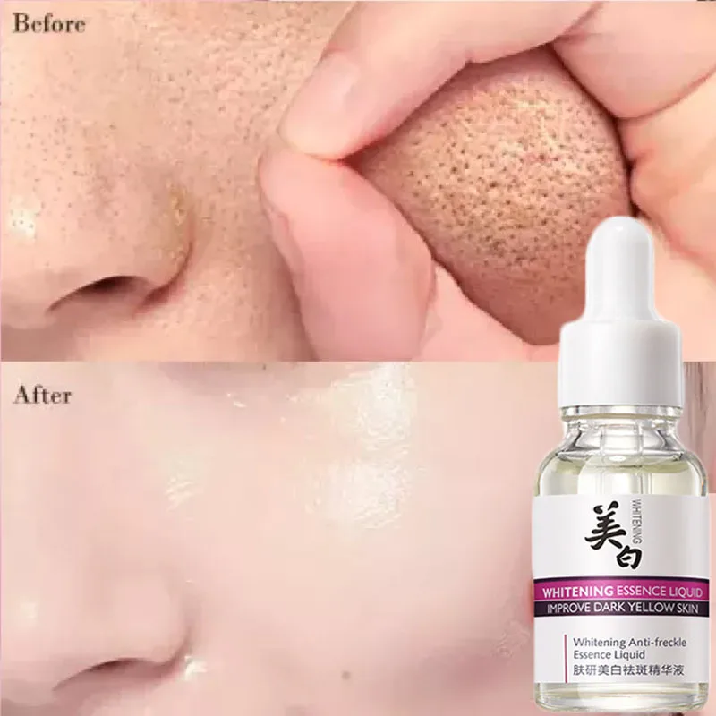 

Nicotinamide Whitening Serum Products Fade Pore Dark Spots Freckle Remove Melasma Melanin Face Cream Brighten Pigment Correction