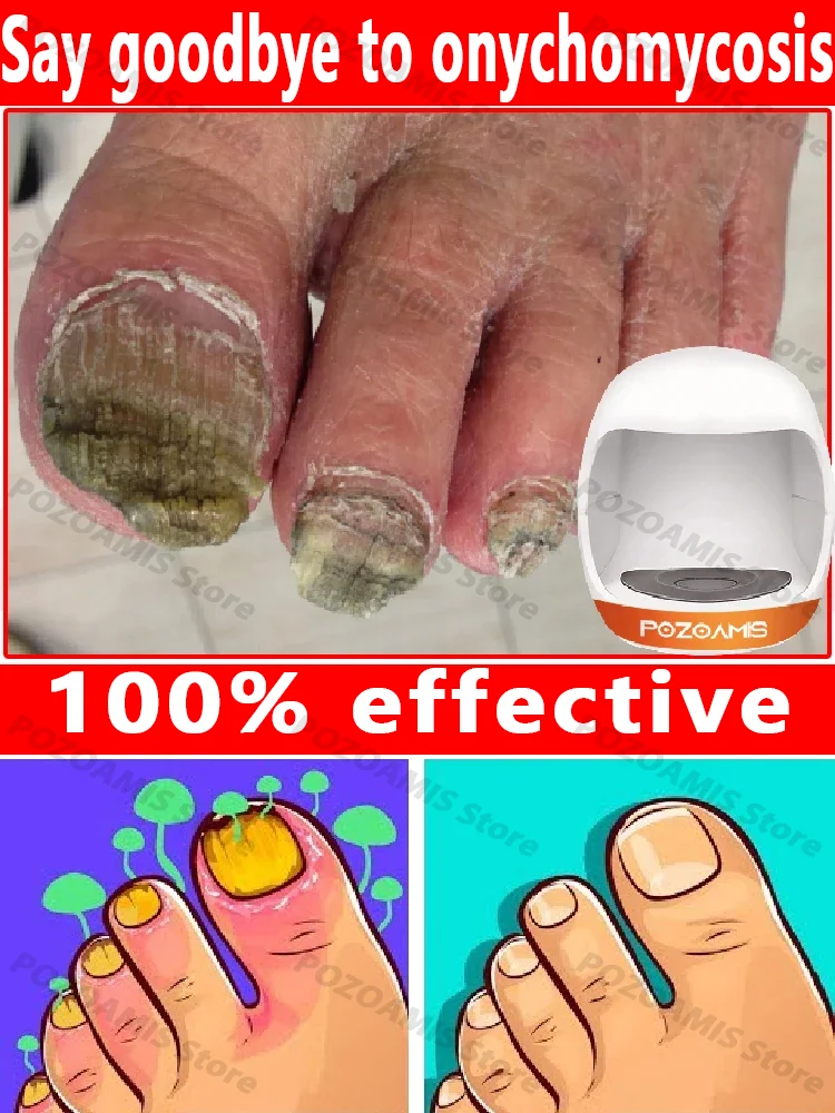 Деформированный маникюрный Терминатор немезис от вросшего кровотечения ногтей