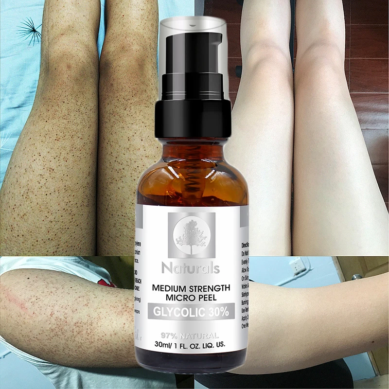 Facial Glycolic Acid 30% Facial Exfoliating Serum Acne Treatment Deep Remove Cleaning All Skin Types Smooth Moisturizing Skin