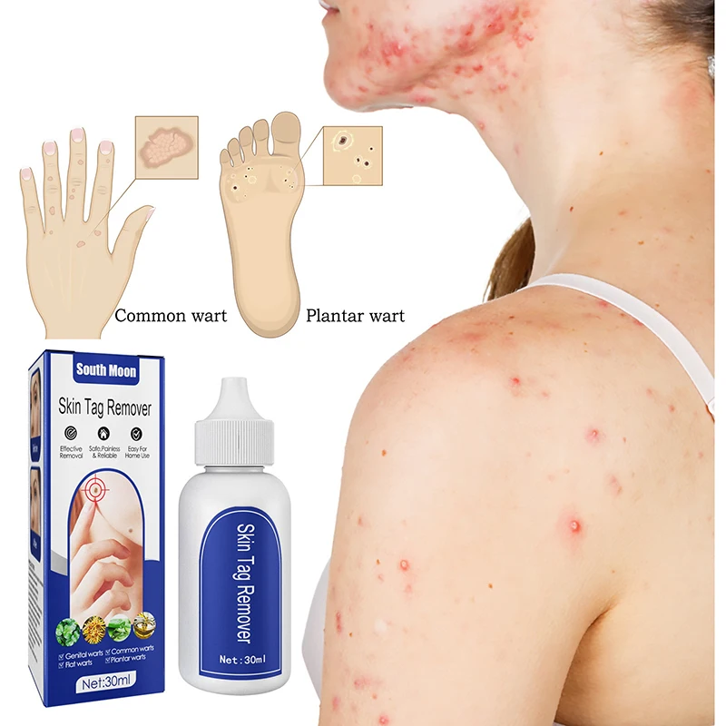 

Средство для удаления бородавок на ногах, бактериостатическая жидкость