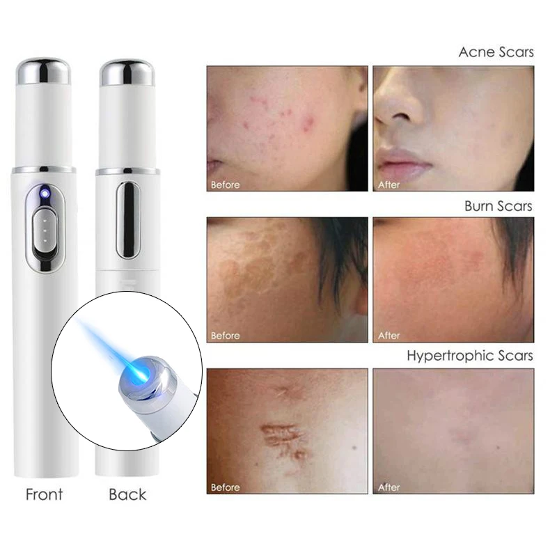 

Лазерная ручка для лечения варикозного расширения вен и удаления шрамов