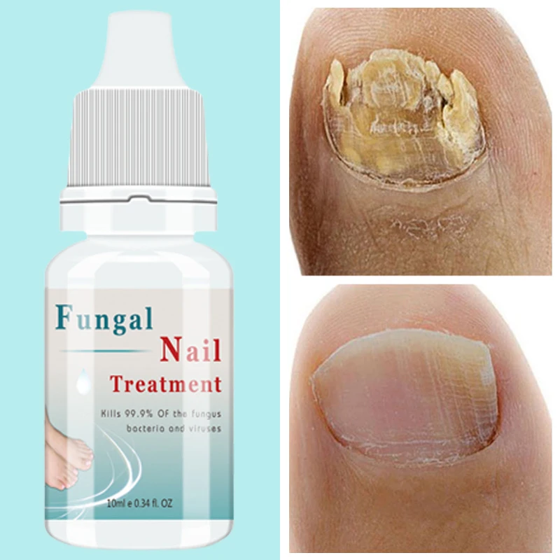 

Nail Fungus Treatment Serum Foot Repair Essence Toe Nails Fungal Removal Gel Anti Infection Paronychia Onychomycosis Cream 10ml