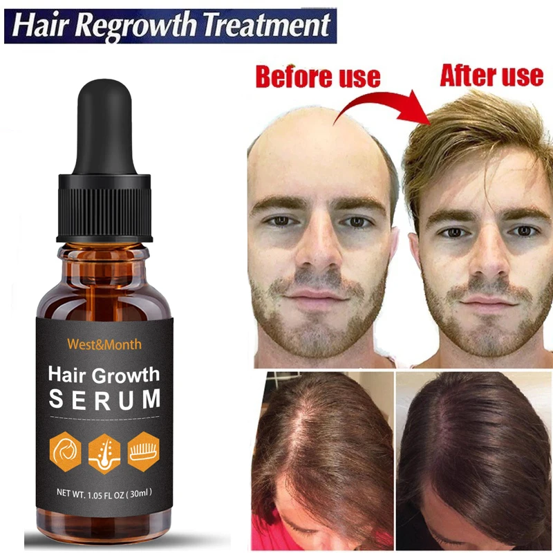 Ginger Hair Growth Essential Oil Anti Hair Loss Serum Prevent Baldness Fast Growing Treatment Repair Damaged Thinning Hair Care
