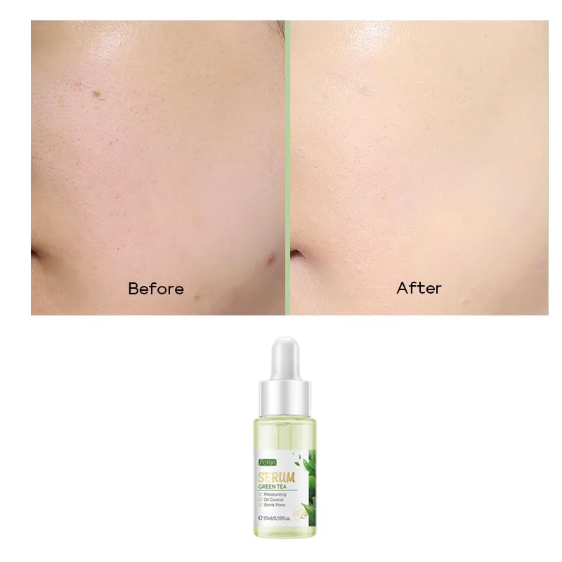 

1Pc 17ml Green Tea Essence Acne Treatment Serum Facial Anti Acne Scar Removal Skin Care Pimple Remover Repair Serum Liquid