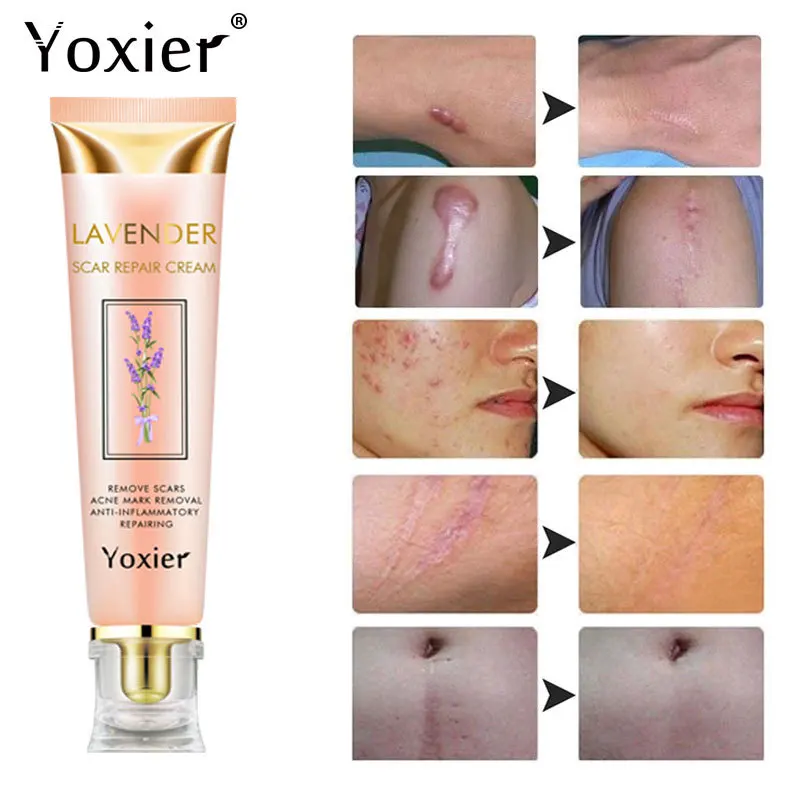 

Крем для восстановления рубцов лаванды, удаление акне, хирургических рубцов, лечение ожога полос, стимулирование регенерации клеток, гладк...