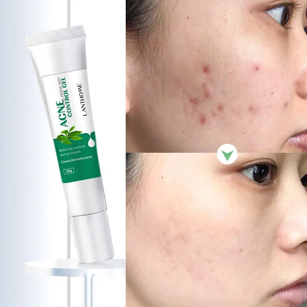 

Масло эффективное для лечения акне и устранения воспалений, 20 г, T6K8