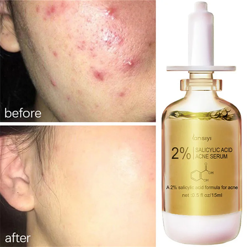 

Anti-Acne Salicylic Acid Serum Repair Spots Acne Scar Hydrating Moisturizing Oil Control Shrink Pore Essence