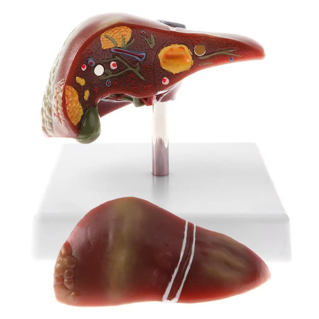 

Ornament Human Diseased Liver Pathology Model Educative Science Toy