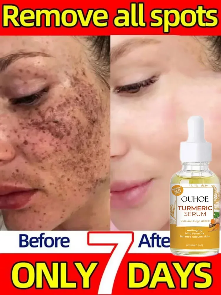 Отбеливающая сыворотка для лица с куркумой осветляющая удаления темных пятен