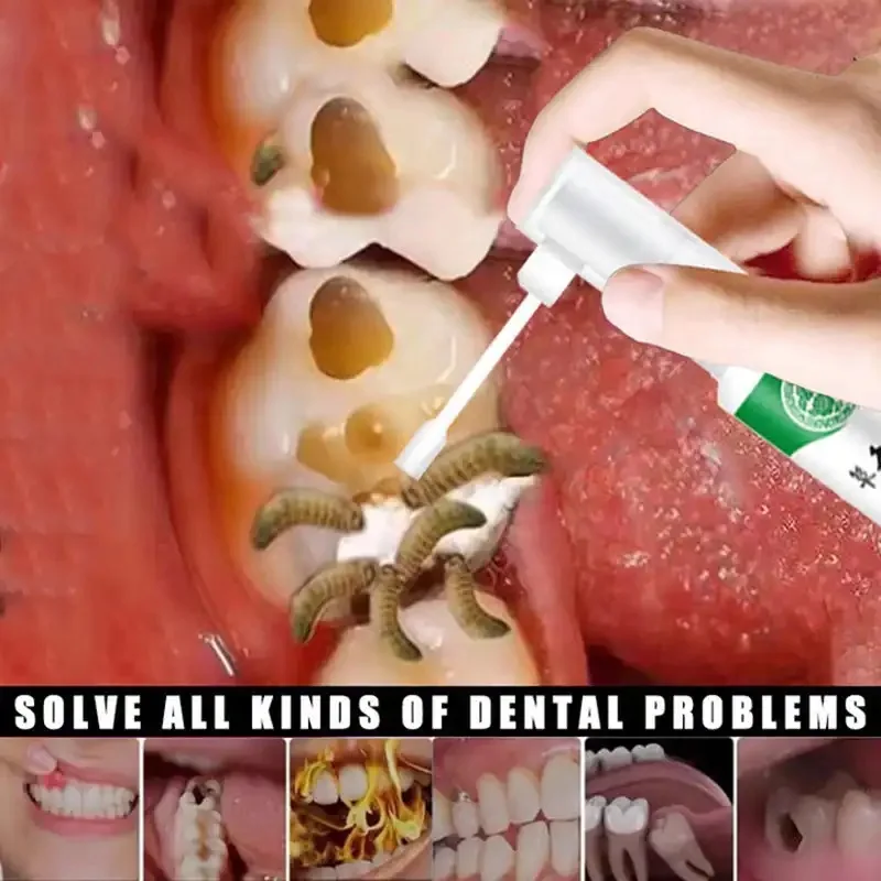 

Tooth Pain Relief Treatment Spray Toothache Cure Teeth Decay Remover Killer Periodontitis Cleaner Angelica Dahurica Medicine