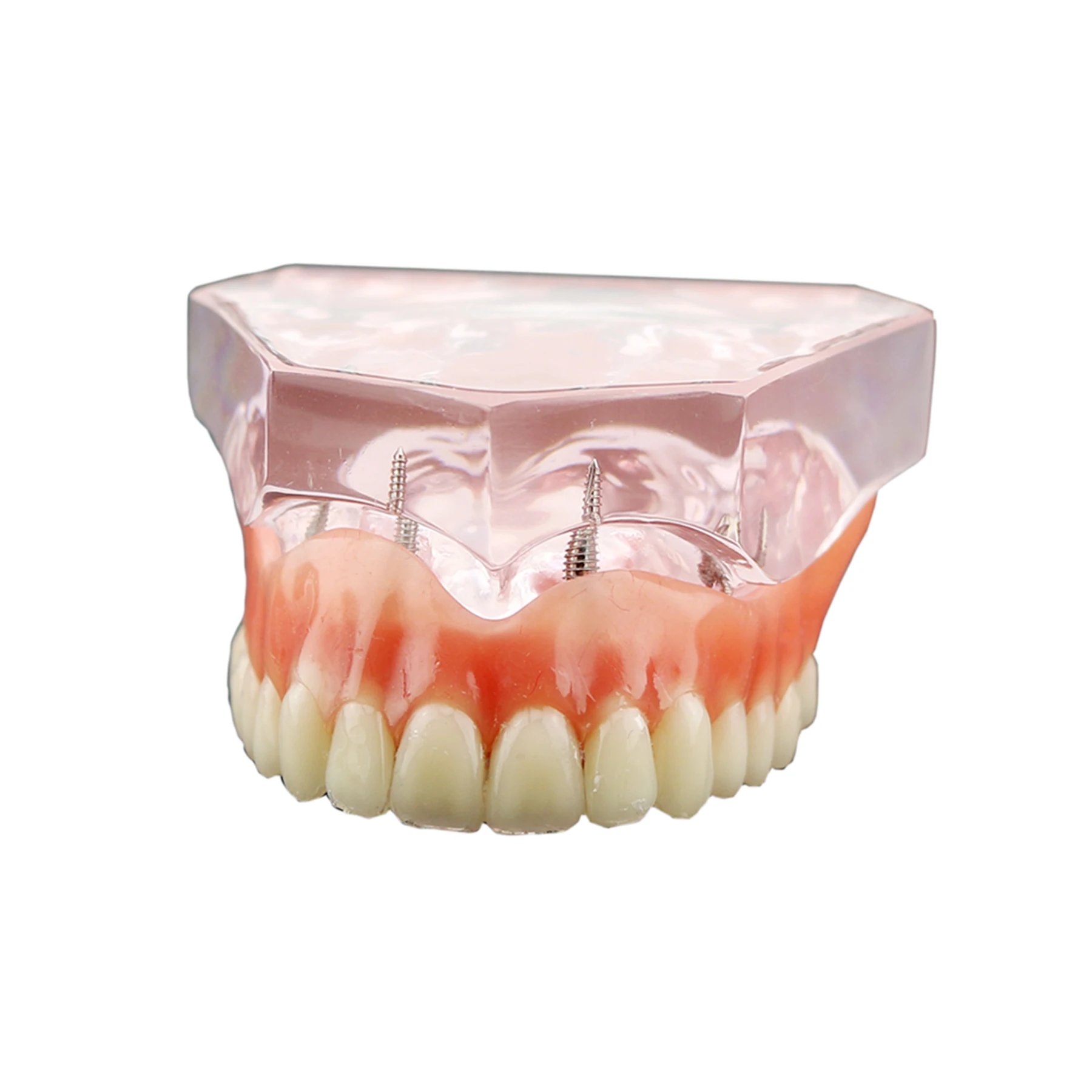 

Dental Implant Teaching Model 4Upper Implants Removable Overdenture Restoration Pink Acrylic Dentist Coolege Demo Model