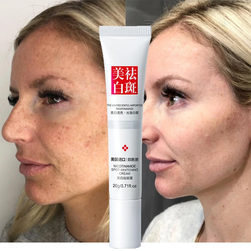 

Whitening Freckle Cream Effective Remove Melanin Dark Spots Pigmentation Melasma Brighten Gel Moisturizing Face Skin Care Cream