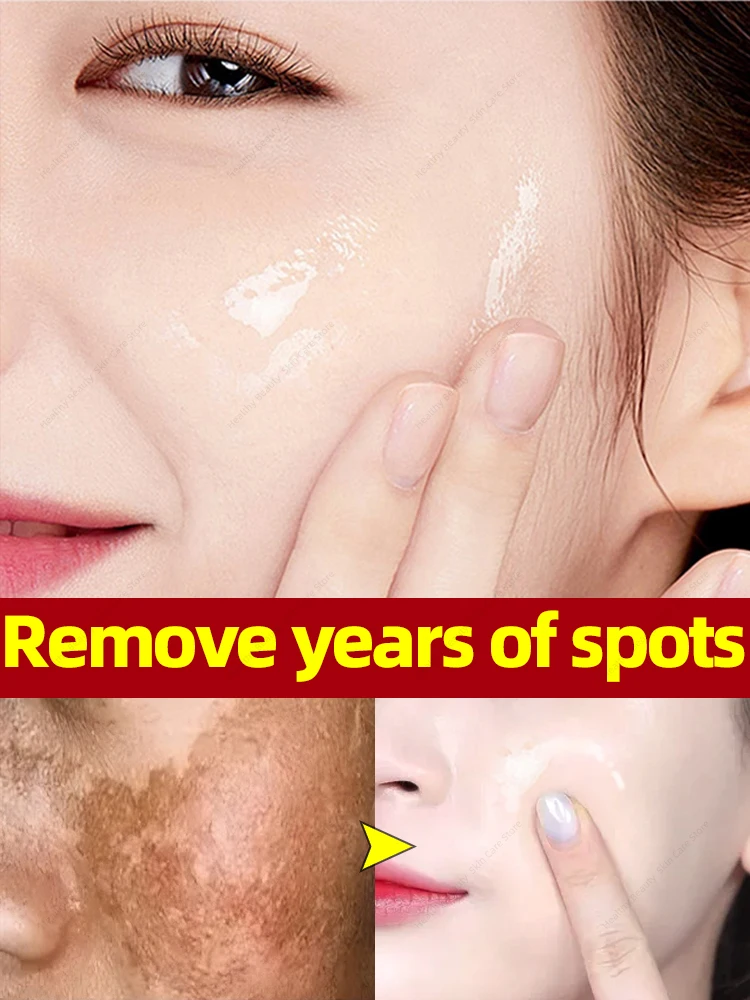 Мелазма темная фотография