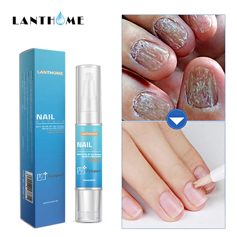 

Nail Fungal Treatment Serum Pen Remedy For Nail Fungus Anti Onychomycosis Paronychia Essence Brightening Repairing Beauty Care