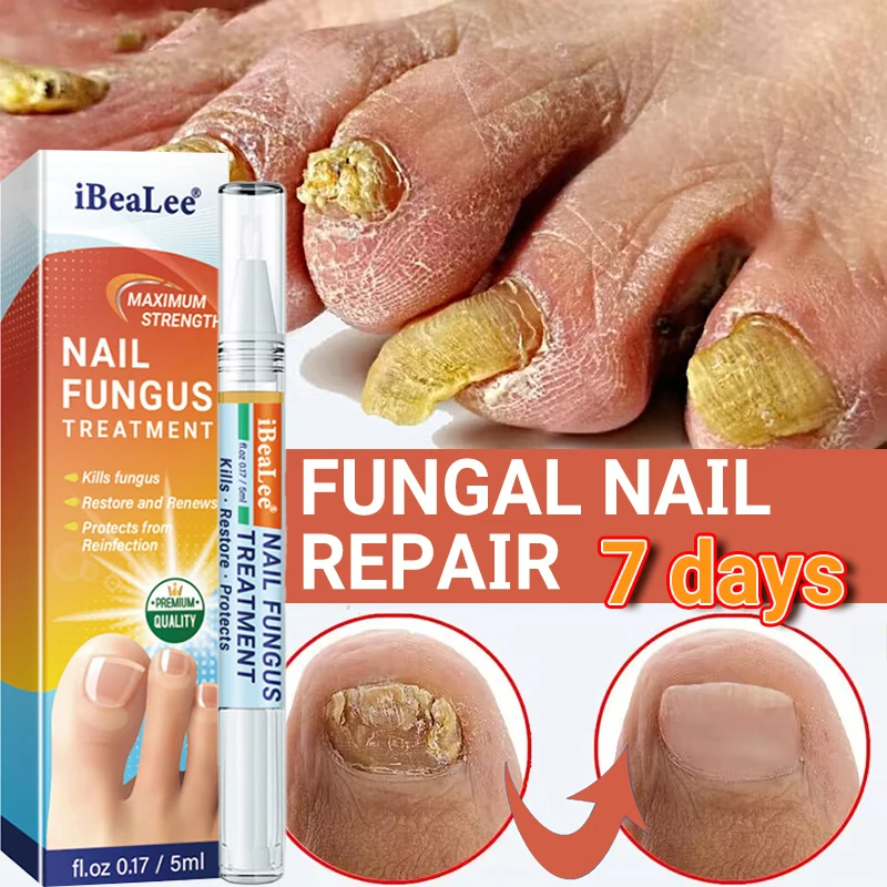 

Nail Fungus Treatment Serum Pen Onychomycosis Paronychia Anti Fungal Nails Infection Repair Essence Hand Foot Beauty Health Care