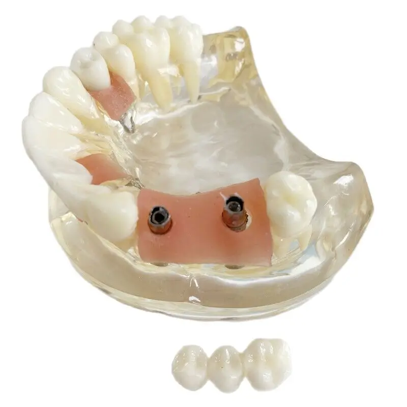 

Стоматологическая модель зубов имплантат Мэрилендского моста, кабинета, Maxillary Jaw Cuspid Molar Miss