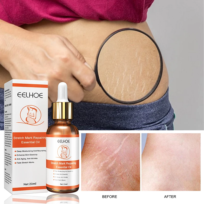 

Maternity Scar Repair Essential Oil Pregnancy Lift Stretch Mark Remove Enhance Skin Care Elasticity Firm Sagging Deep Moisturize