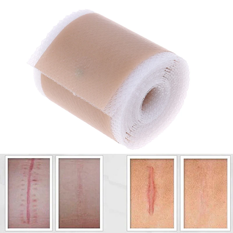 Silicone Sheet Efficient Surgery Scar Removal Gel Sheet Therapy Patch for Acne Trauma Burn Scar Skin Repair Scar Treatment