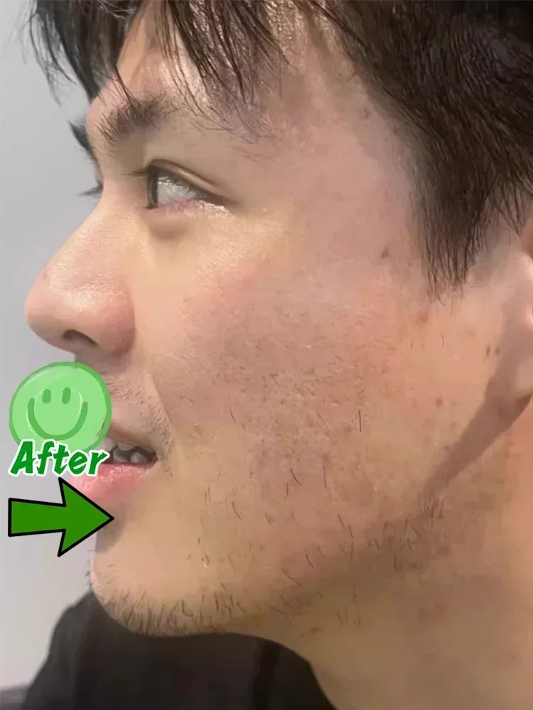 Мужской крем для восстановления отверстий против прыщей устраняющий отверстие