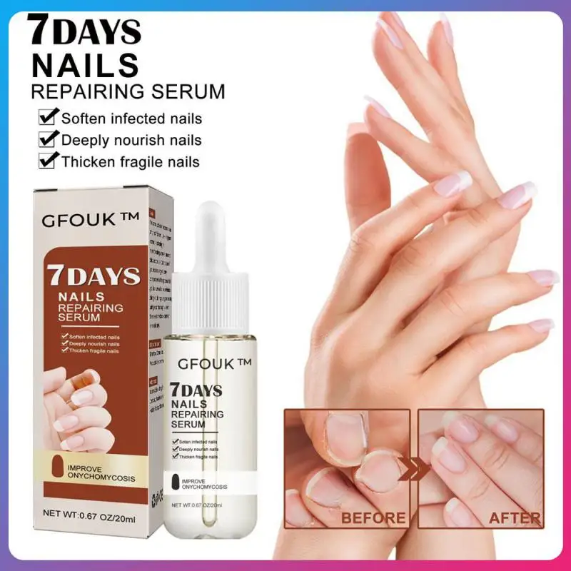 

Онихомикоз восстанавливает Лёгкость в использовании, восстанавливает кожу, восстанавливает кожу, делает грибки нежными, 1 шт. жидкости для ...