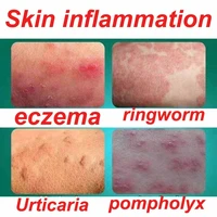 herbal antibacterial cream psoriasis cream anti itch relief eczema skin rash urticaria desquamation treatment