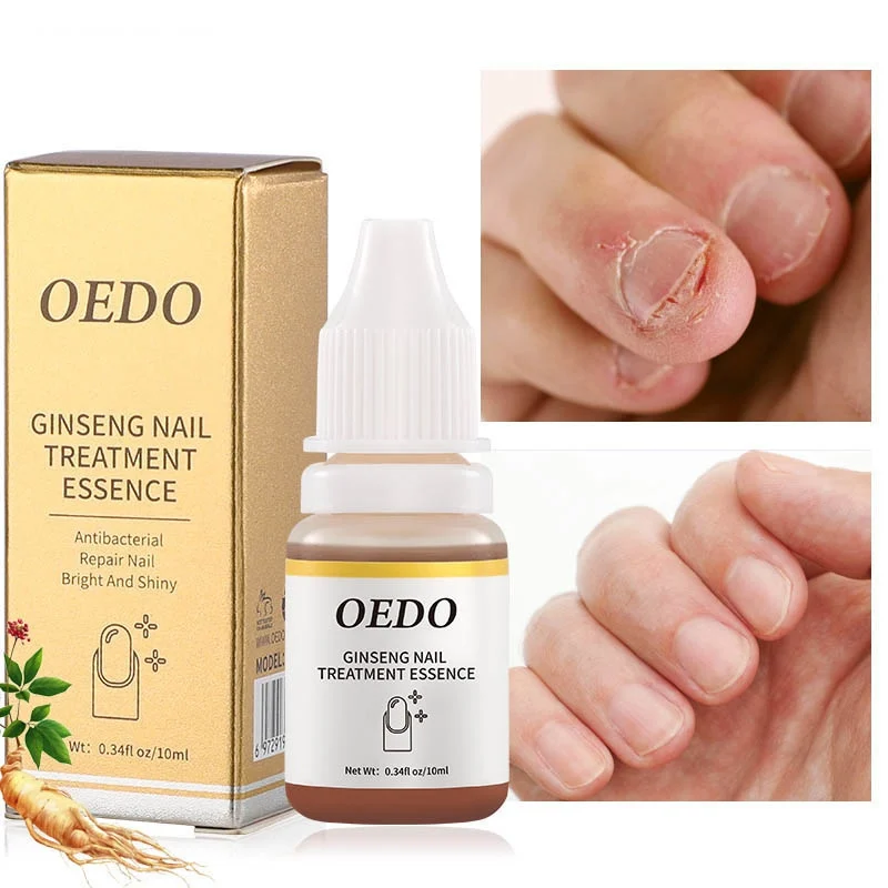 

Жидкость для ногтей, увлажнение, натуральный Уход за ногтями, противогрибковое лечение, удаление грибка, горячее удаление