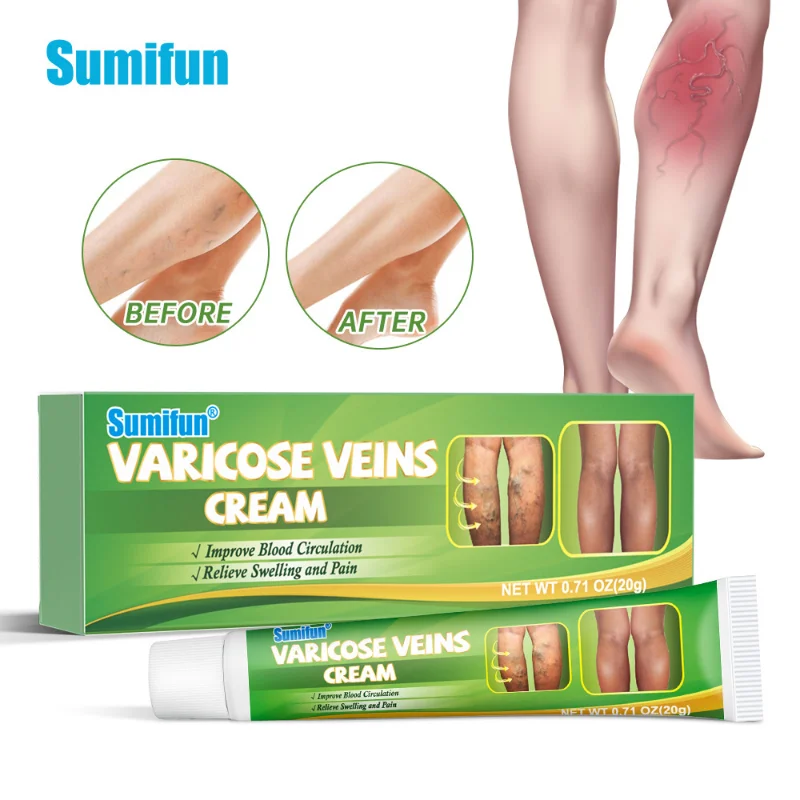 

Ointment for varicose veins Effective varicose vein relief cream to relieve vasculitis phlebitis spider pain treatment skin Care