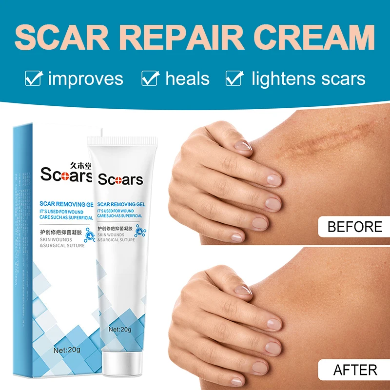 

Крем для удаления шрамов от акне, уход за кожей, лечение растяжек, восстановление пятен, блестящий увлажняющий Гладкий уход за кожей тела