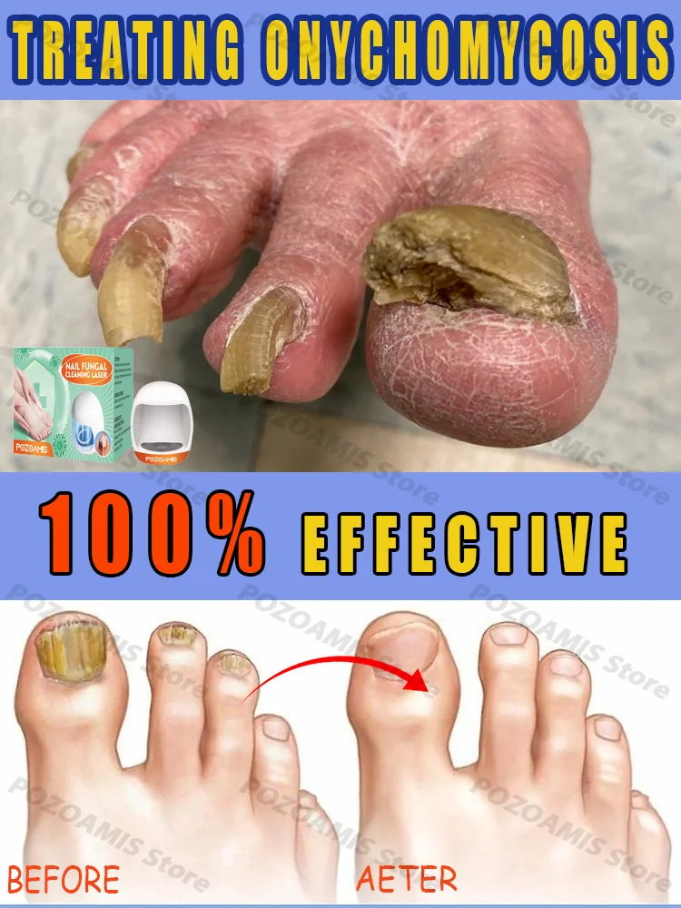 Деформированный терминал для ногтей Немезида кровотечения вросших