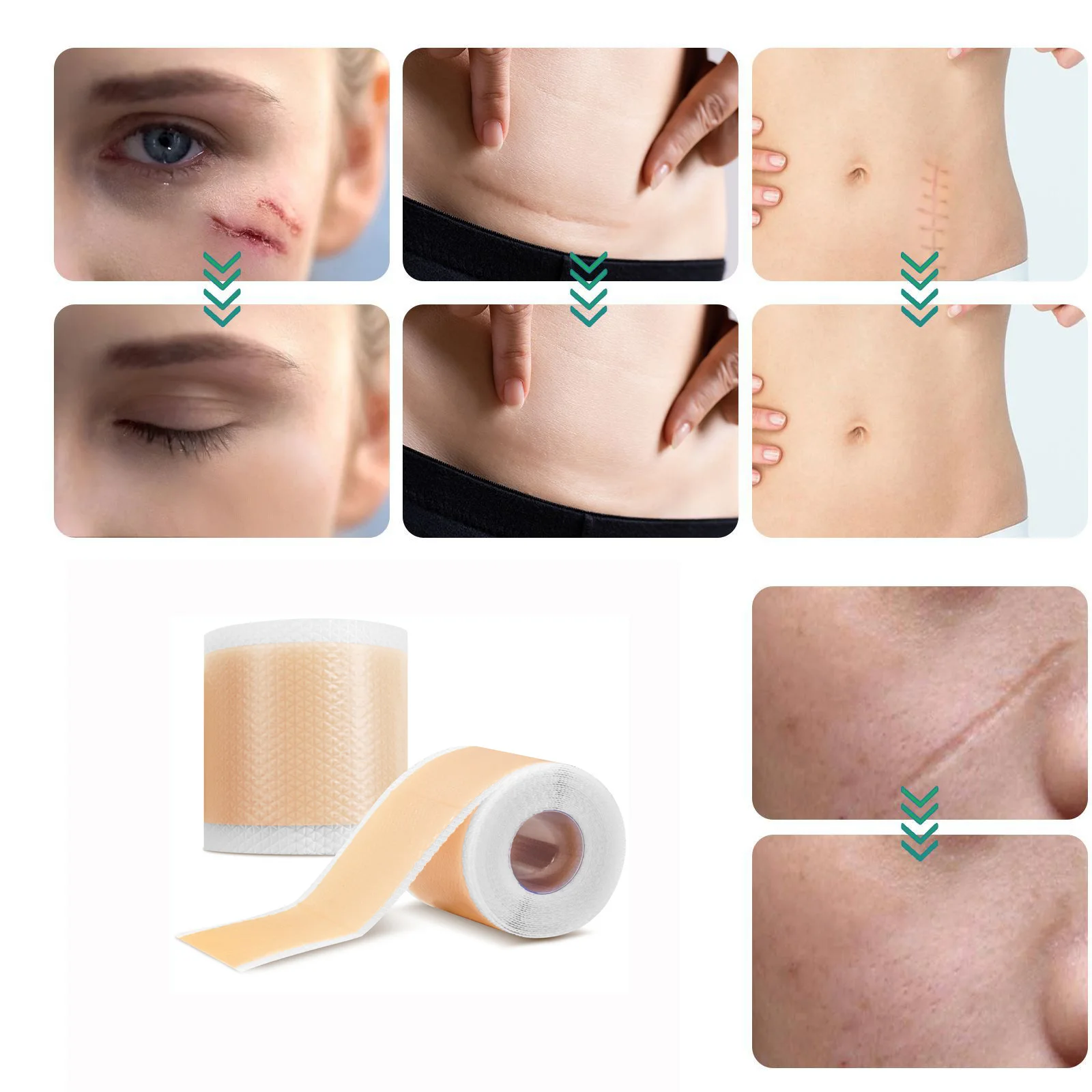 Силиконовые полоски для удаления шрамов от прыщей 300 см