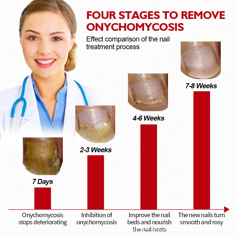 

Гигиеническая жидкость для ухода за кожей рук, ног, онихомикоз, осветляющая мягкая жидкость для ногтей, бактериальное очищение, питательное...