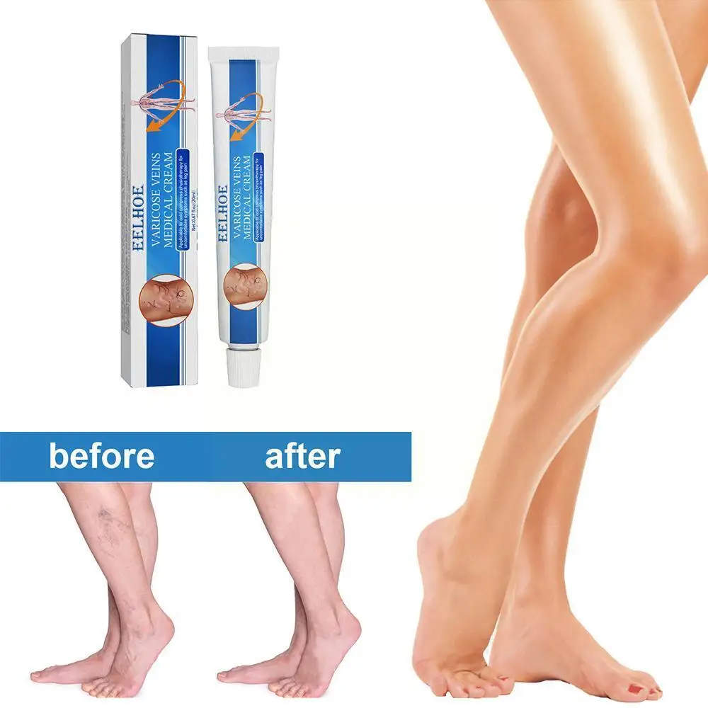 

16g Varicose Veins Treatment Cream Varicosity Legs Remedy Crea Phlebitis Veins Pain Relief Veins Varicose Ointment Z6L7