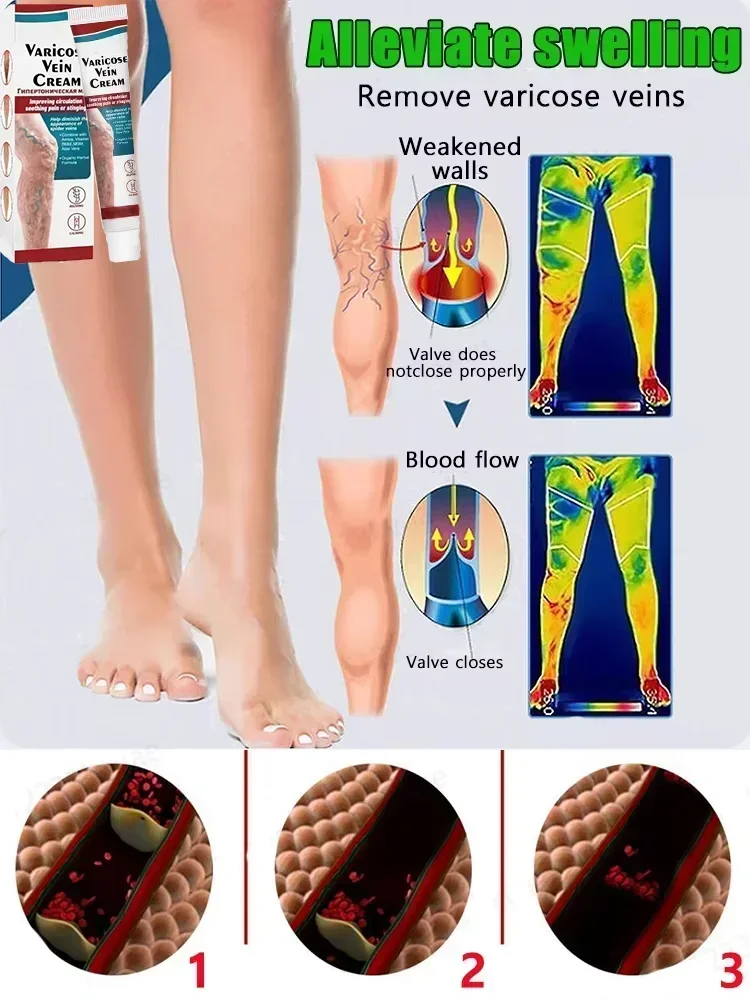 Кровяные сосуды Spider эффективное облегчение варикозного расширения вен