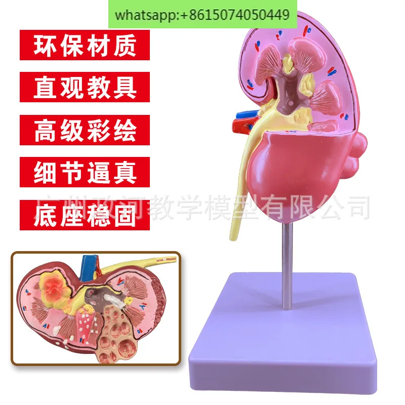 Моделирование обучения модель патологической почки образец почечной анатомии