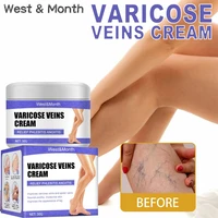 phlebitis blood vessel rotten vein care fading cream legs varicose veins cream herbal ointment vasculitis treatment