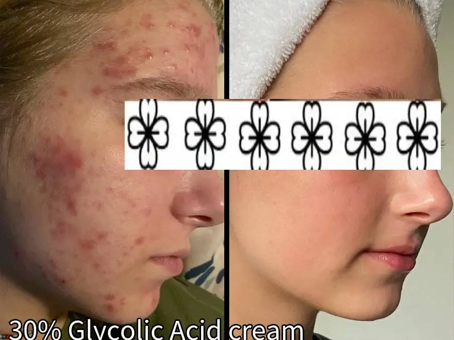 

30% Glycolic Acid Cream With Salicylic, Exfoliating Resurfacing AHA Facial Cream For Skin Toning Blemish Control Pigmentation
