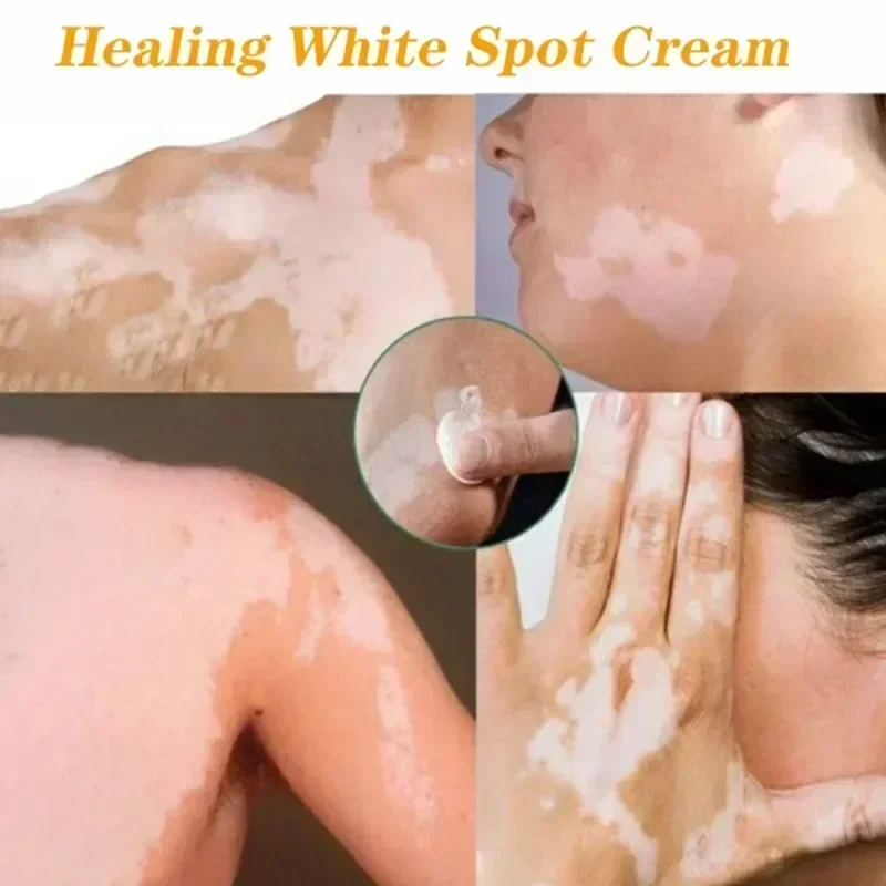 Лечебный крем для Vitiligo лечение кожи удаление белых пятен мазь устранение лечения
