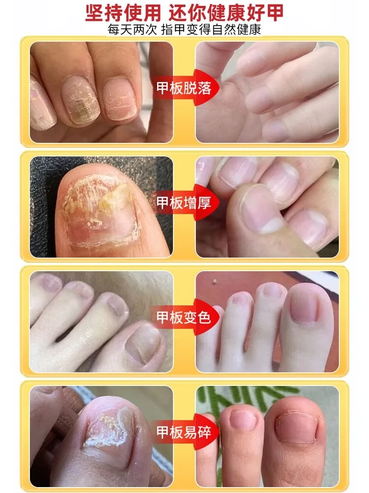 [Watsons Hot Sale] It Is Invalid to Remove 99% Gray Potassium Fungus without Packing Or Repairing a Drop!!!