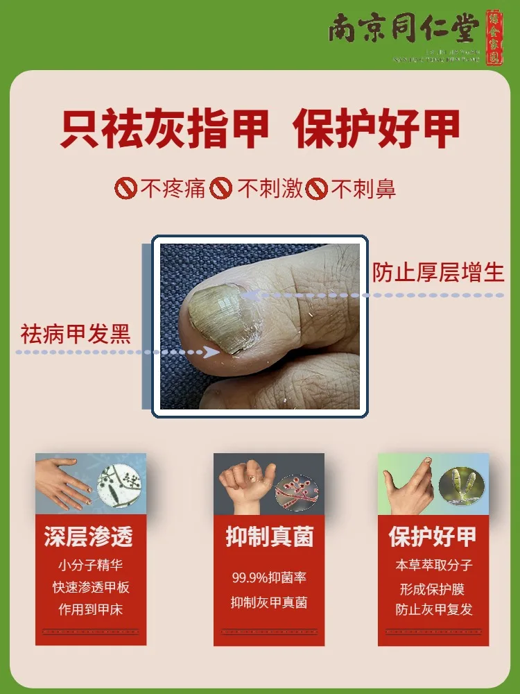 [Watsons Hot Sale] It Is Invalid to Remove 99% Gray Potassium Fungus by Dropping a Drop of Antibacterial and Not Removing Nail!!