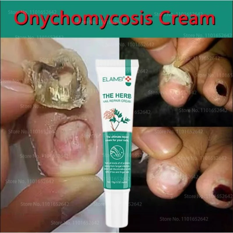 

Nail Care Cream Nail Repair Cream Onychomycosis Herbal Ingredients Soothing Nail Nail Antifungal Nutrition Cream 15g 네일 리페어 크림