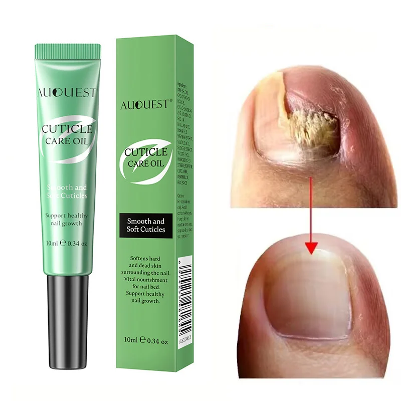 

AUQUEST Nail Fungus Treatment Serum Anti Infection Toe Nails Fungal Removal Cuticle Care Oil Paronychia Onychomycosis Repair Gel