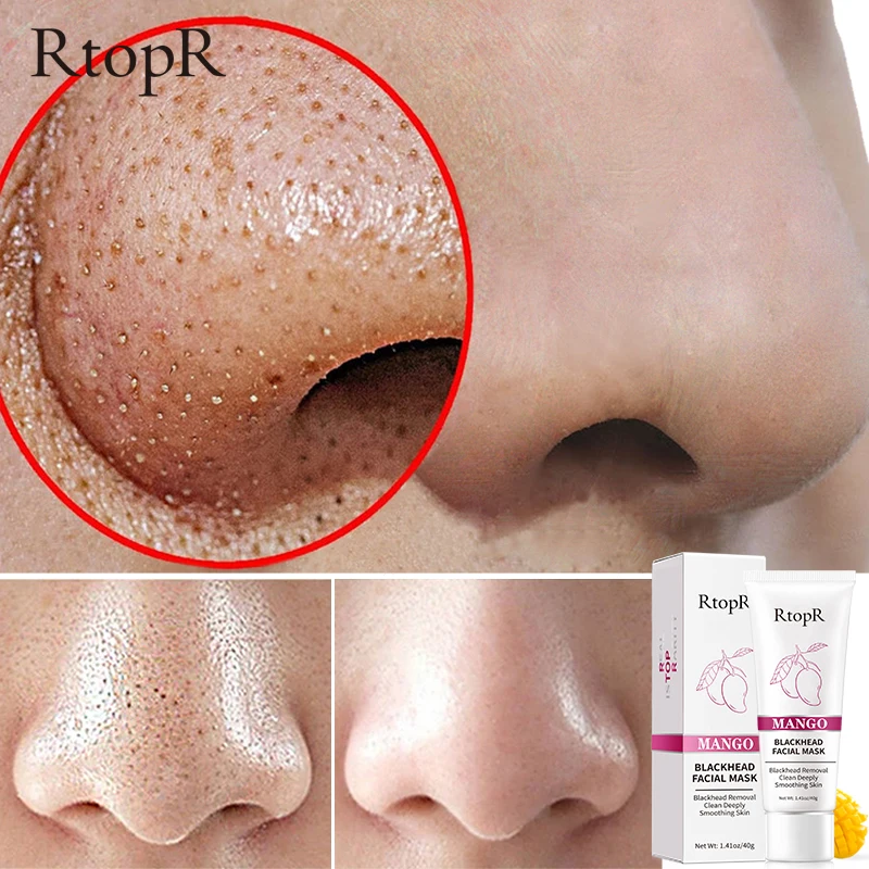 Средство для удаления черных точек с манго лечение акне контроль жирности носа